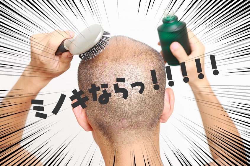日本で発毛効果が認められている成分、ミノキシジル